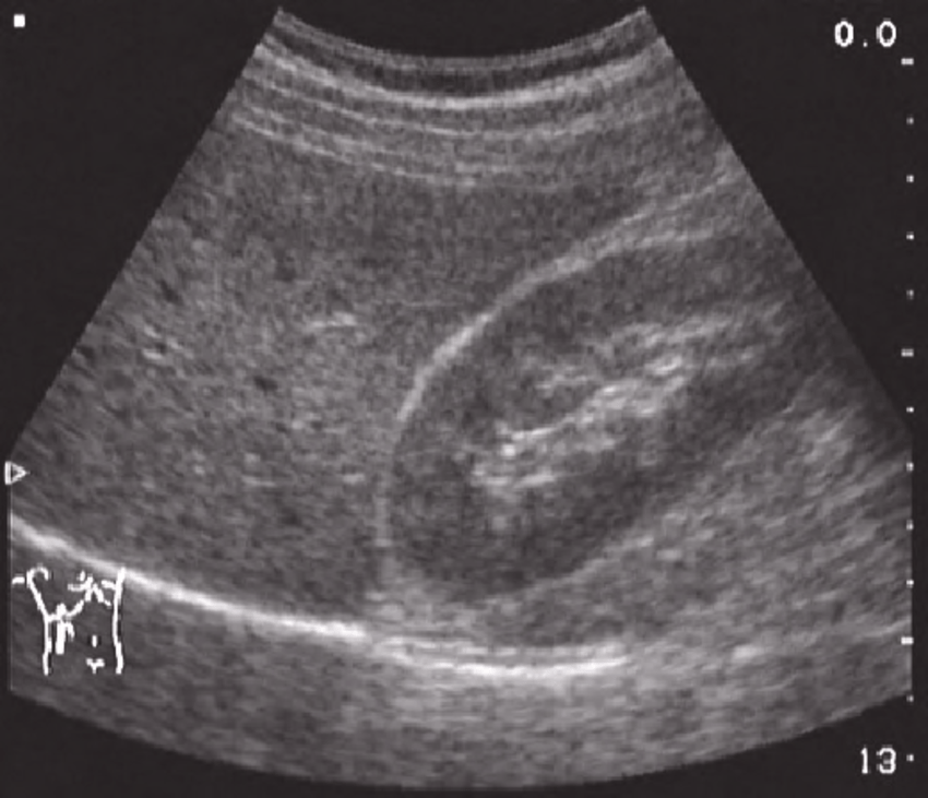 Normal-ultrasound-liver-pattern-Echogenicity-and-echodensity-of-the-liver-and-the-kidney